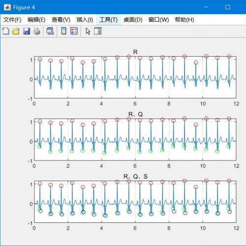 基于Matlab的心电ECG信号RQS波检测程序